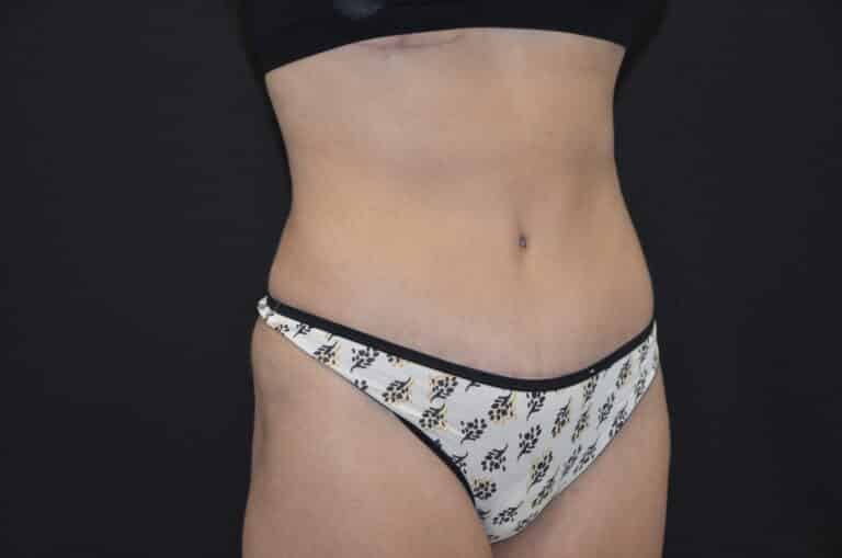 After Image: Tummy Tuck - right-front-oblique