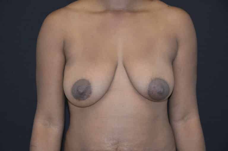 Before Image: Breast Lift - front