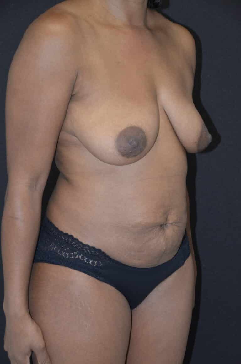 Before Image: Mommy Makeover - right-front-oblique