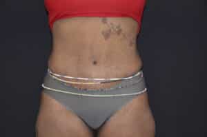 After Image: Tummy Tuck