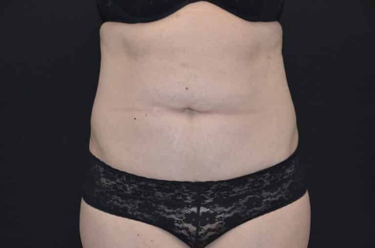 Before Image: Tummy Tuck - front