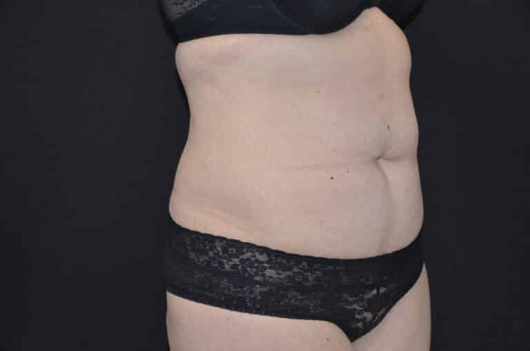 Before Image: Tummy Tuck - right-front-oblique