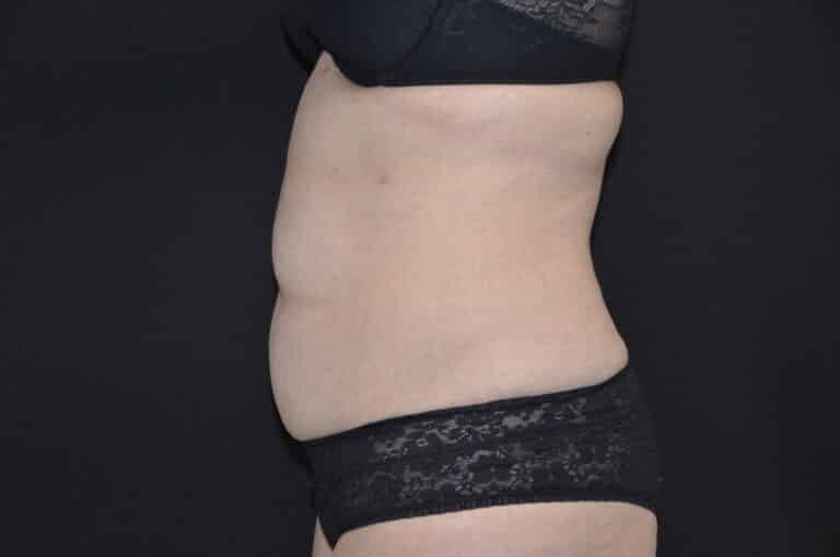 Before Image: Tummy Tuck - left-side