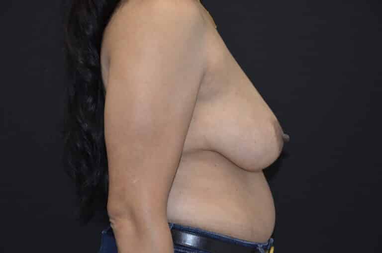 Before Image: Breast Lift - right-side