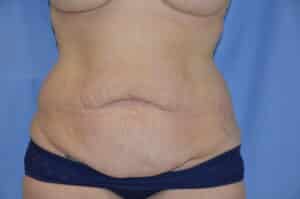 Before Image: Tummy Tuck