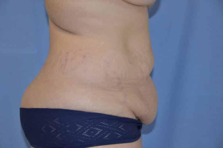 Before Image: Tummy Tuck - right-side