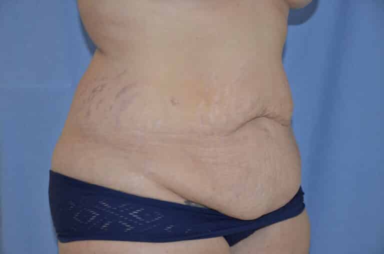 Before Image: Tummy Tuck - right-front-oblique