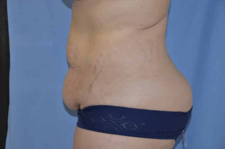 Before Image: Tummy Tuck - left-side