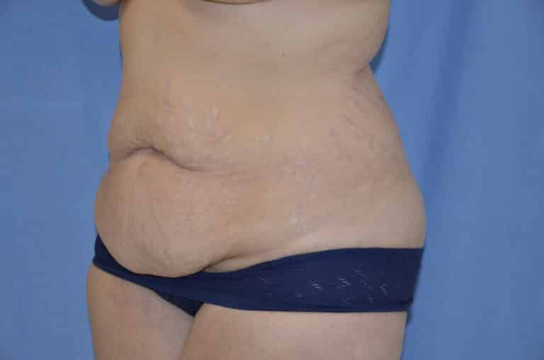 Before Image: Tummy Tuck - left-front-oblique