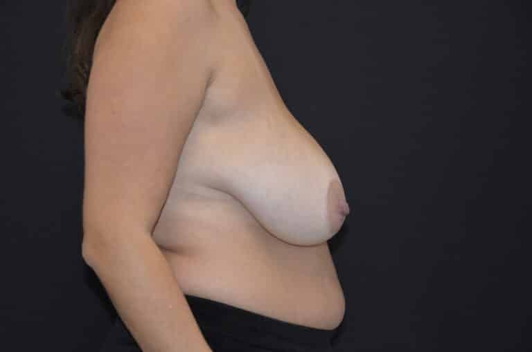 Before Image: Breast Reduction - right-side