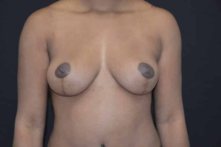 After Image: Breast Lift - front