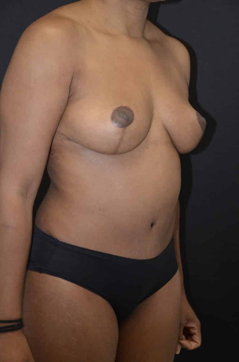 After Image: Mommy Makeover - right-front-oblique