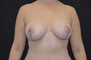 After Image: Breast Lift with Implants