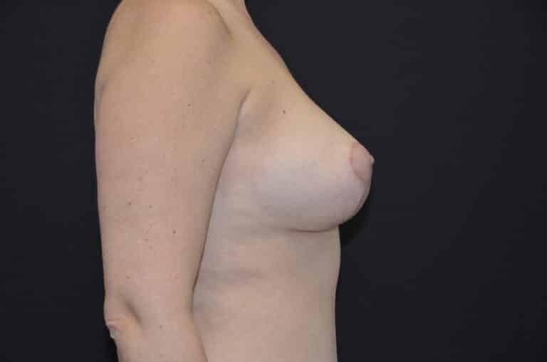 After Image: Breast Lift with Implants - right-side