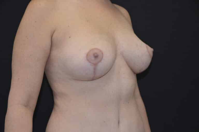 After Image: Breast Lift with Implants - right-front-oblique