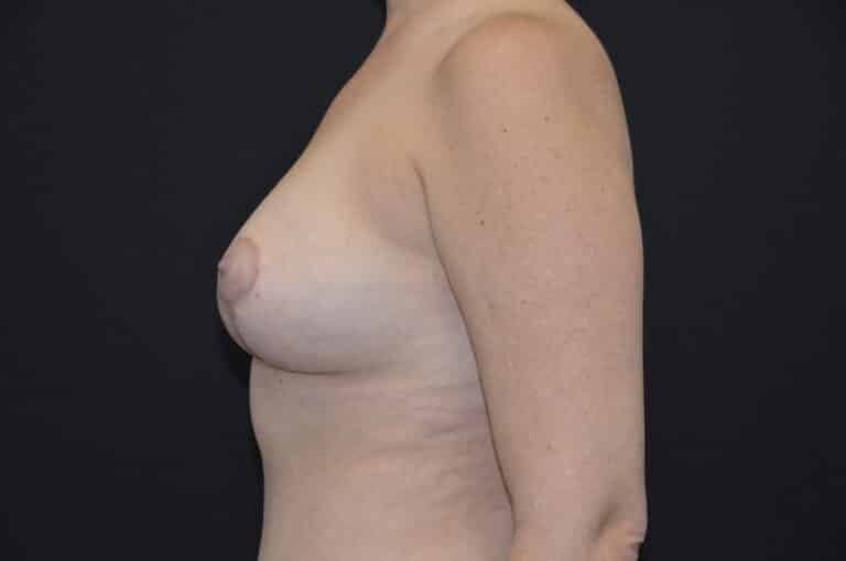 After Image: Breast Lift with Implants - left-side