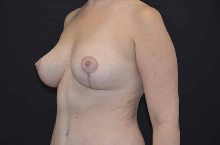 After Image: Breast Lift with Implants - left-front-oblique