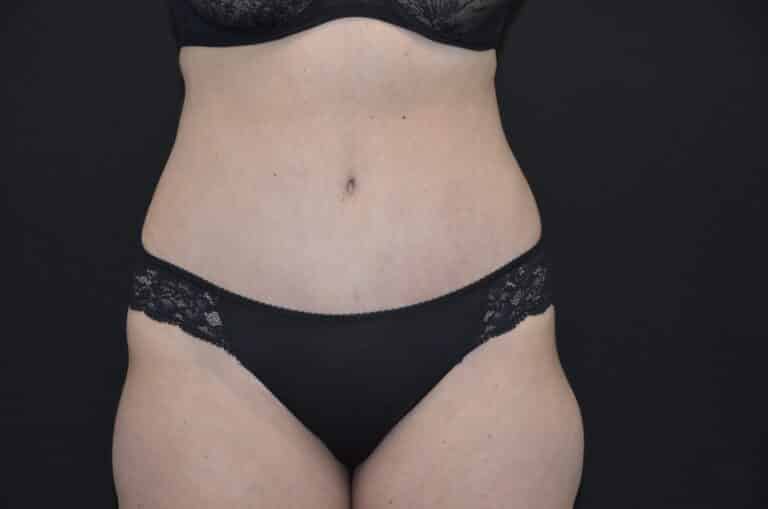 After Image: Tummy Tuck - front