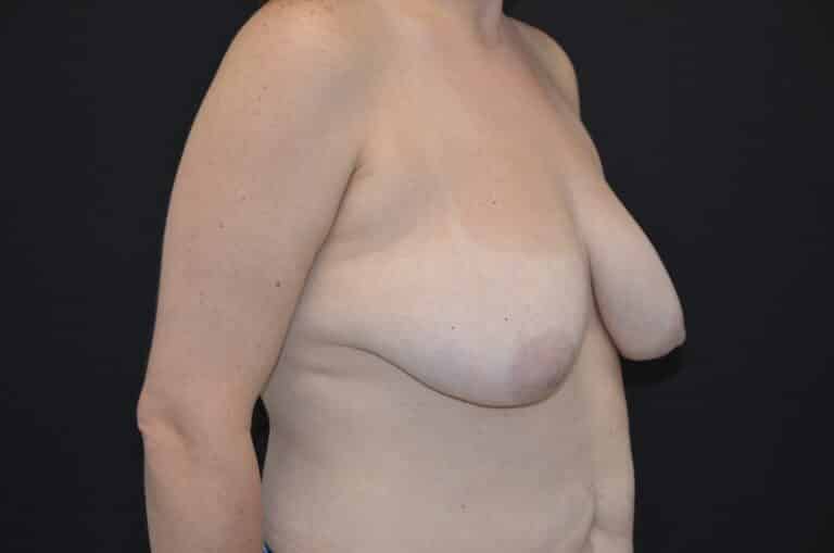 Before Image: Breast Lift with Implants - right-front-oblique