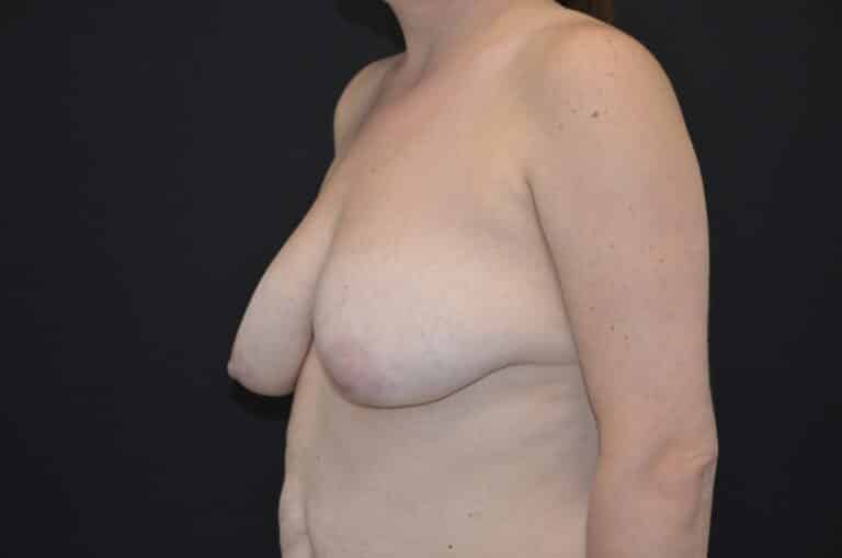 Before Image: Breast Lift with Implants - left-front-oblique