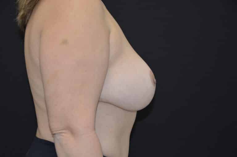 After Image: Breast Lift with Implants - right-side