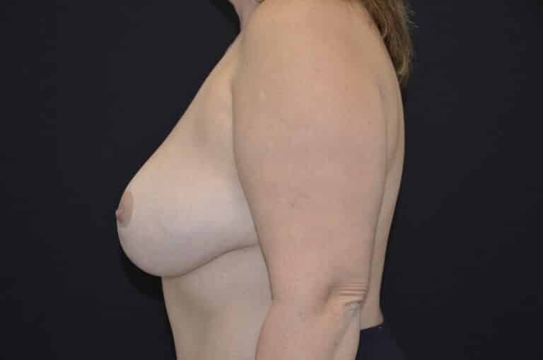 After Image: Breast Lift with Implants - left-side