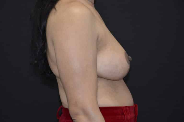 After Image: Breast Lift - right-side