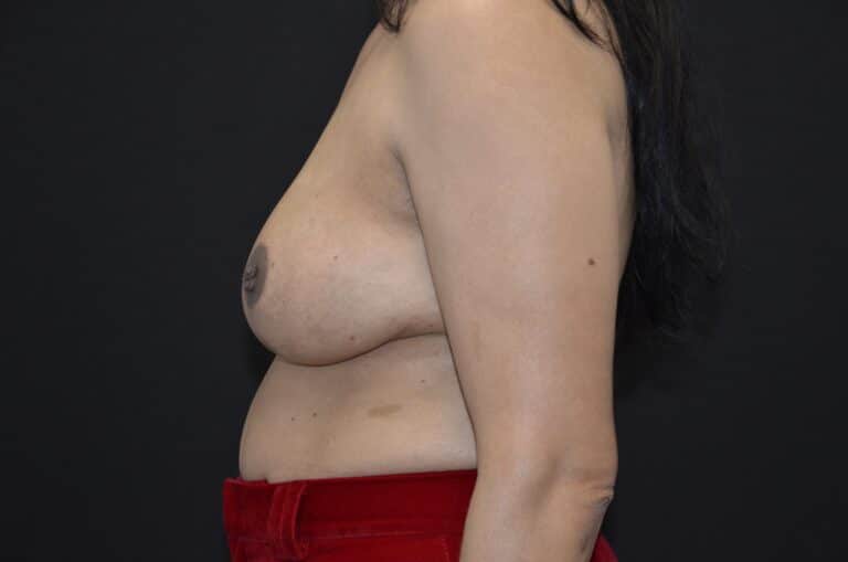 After Image: Breast Lift - left-side