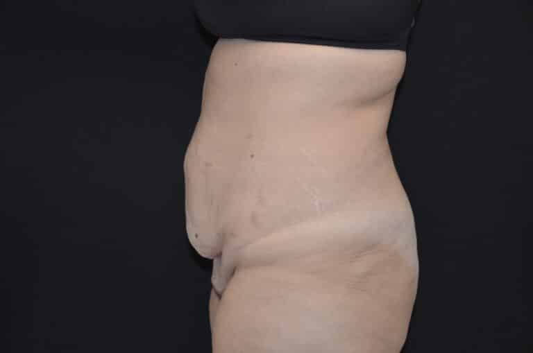 Before Image: Tummy Tuck - left-side