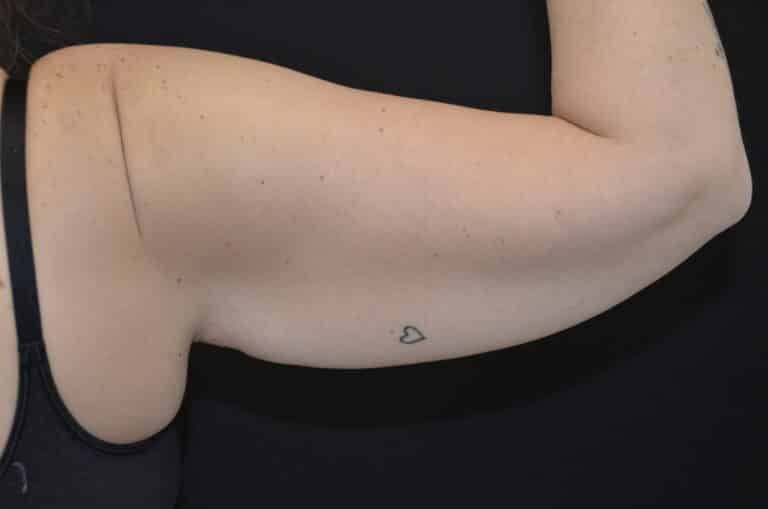 Before Image: Brachioplasty - back