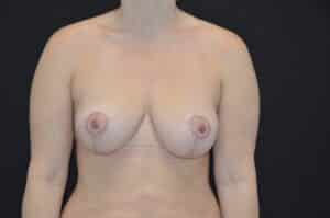 After Image: Breast Lift