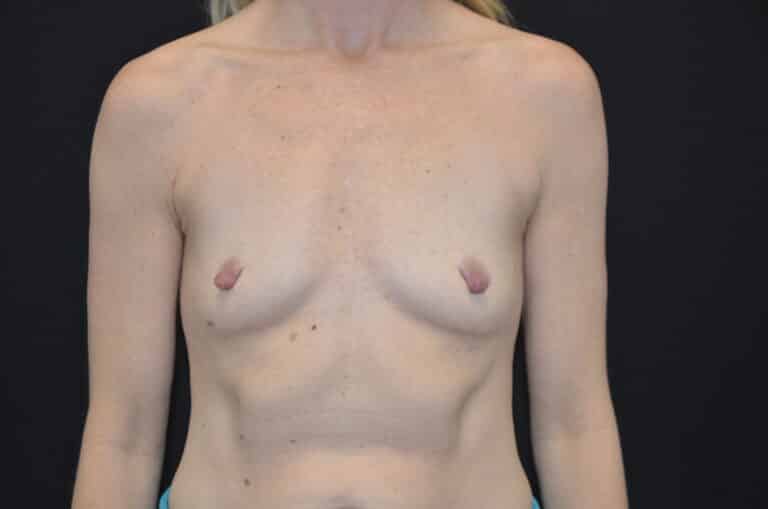 Before Image: Breast Augmentation - front