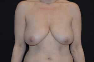 Before Image: Breast Lift with Implants