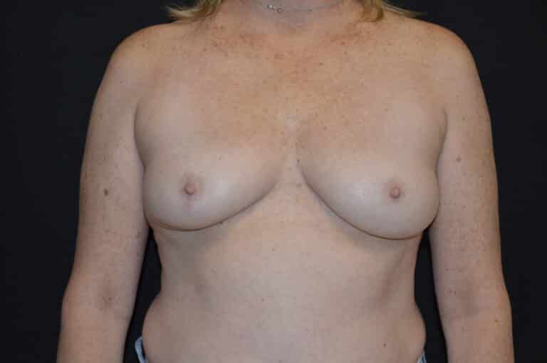 Before Image: Breast Augmentation - front