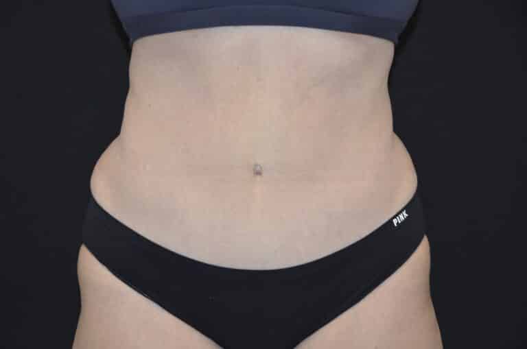 After Image: Tummy Tuck - front