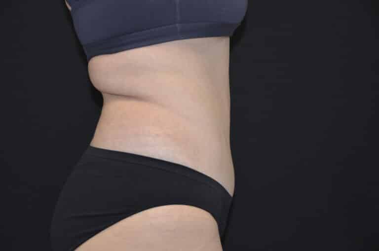 After Image: Tummy Tuck - right-side