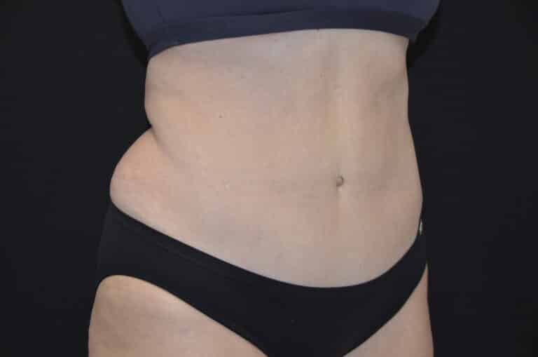 After Image: Tummy Tuck - right-front-oblique