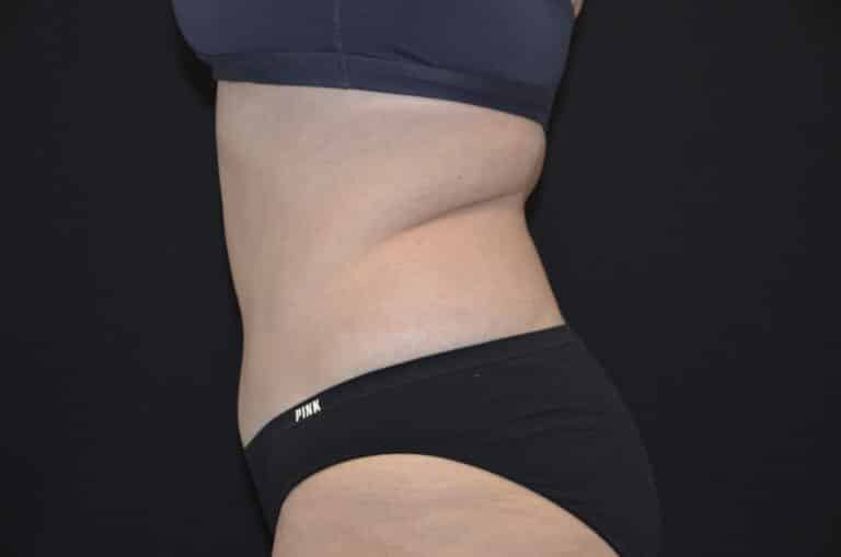 After Image: Tummy Tuck - left-side