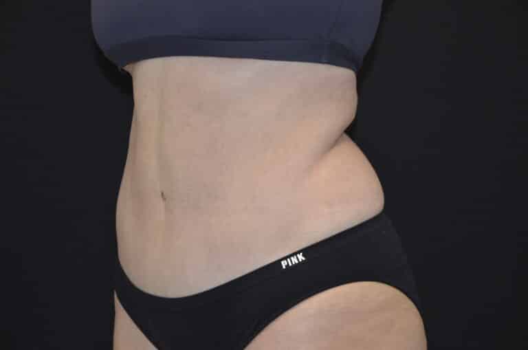 After Image: Tummy Tuck - left-front-oblique