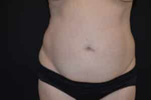 Before Image: Tummy Tuck