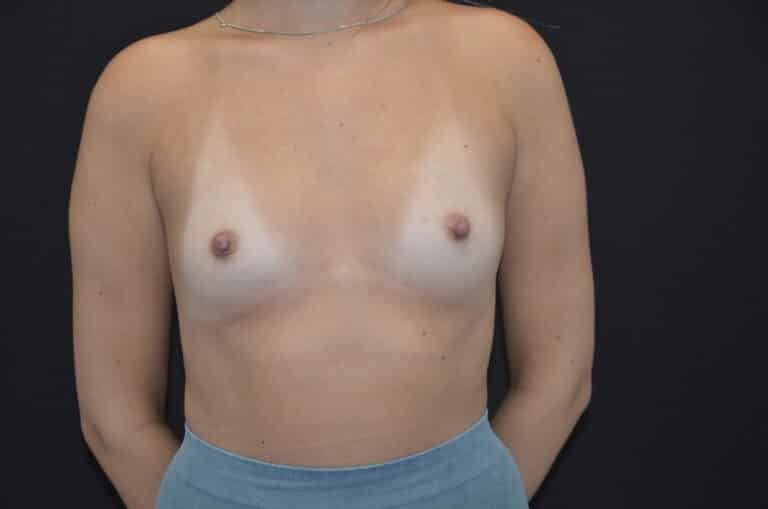 Before Image: Breast Augmentation - front