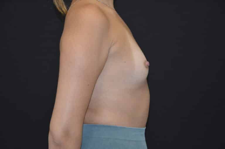 Before Image: Breast Augmentation - right-side