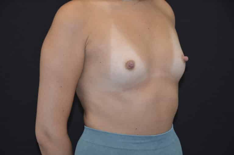 Before Image: Breast Augmentation - right-front-oblique