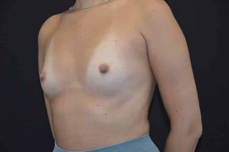 Before Image: Breast Augmentation - left-front-oblique