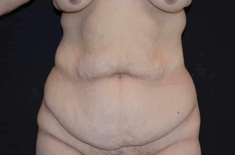 Before Image: Tummy Tuck - front