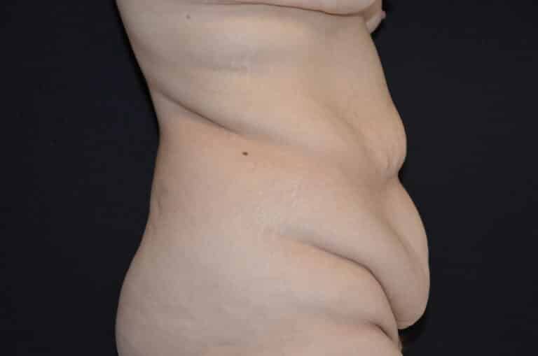 Before Image: Tummy Tuck - right-side