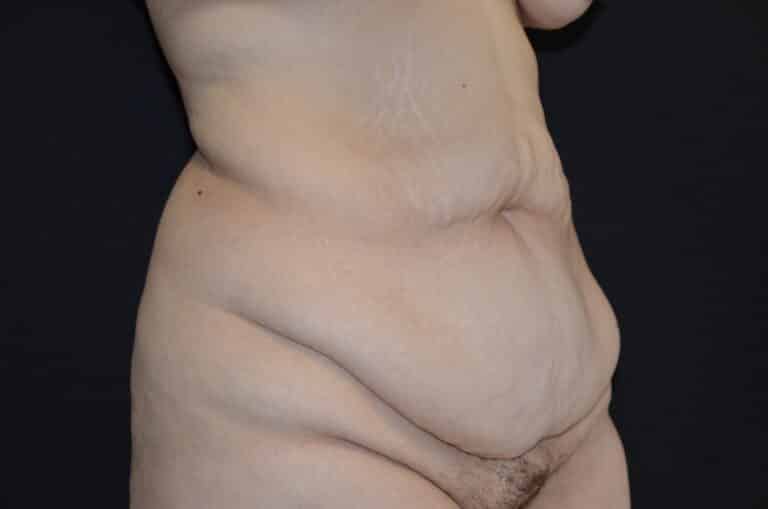 Before Image: Tummy Tuck - right-front-oblique