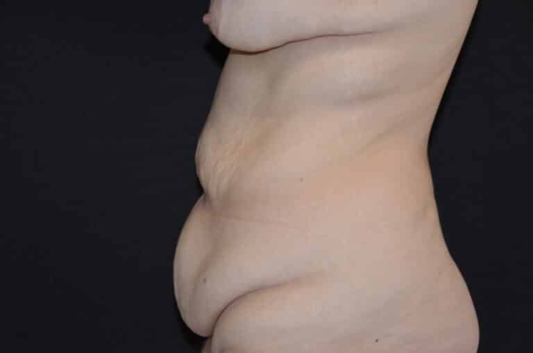 Before Image: Tummy Tuck - left-side