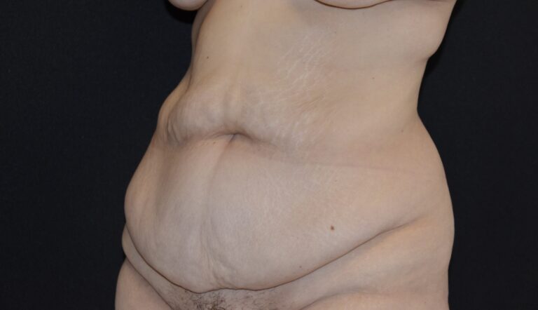 Before Image: Tummy Tuck - left-front-oblique