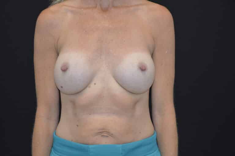 After Image: Breast Augmentation - front